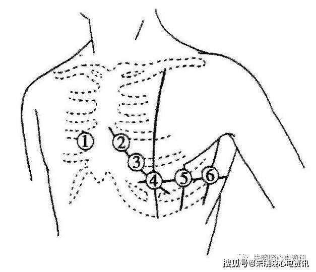 圖2-1 胸前導聯v1～v6的位置胸前導聯又稱威爾遜(wilson)導聯,它的