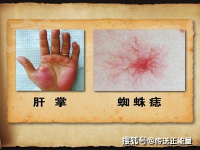 肝脏|肝生病，身体知！身体若有这4种“表现”，别不当回事