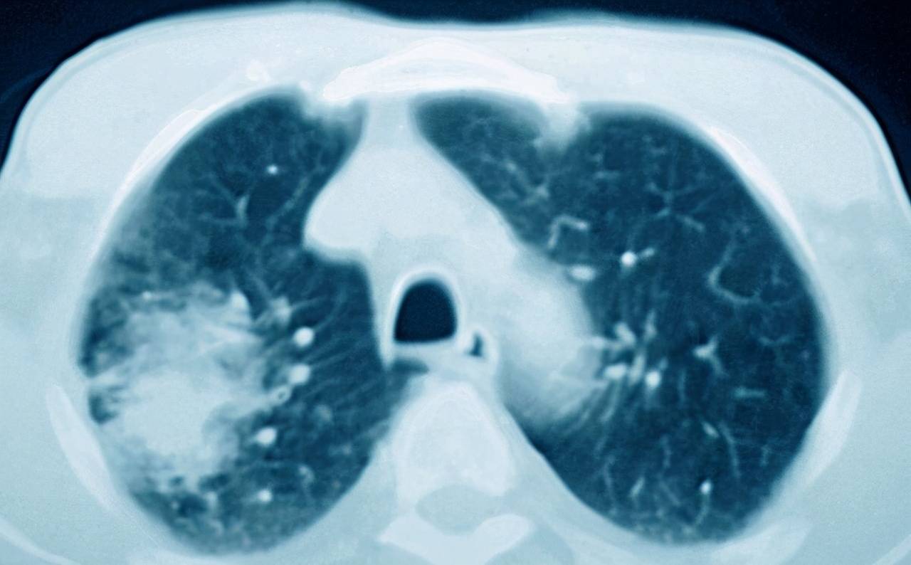 肺积水的治疗主要是什么原因造成的如何治疗呢
