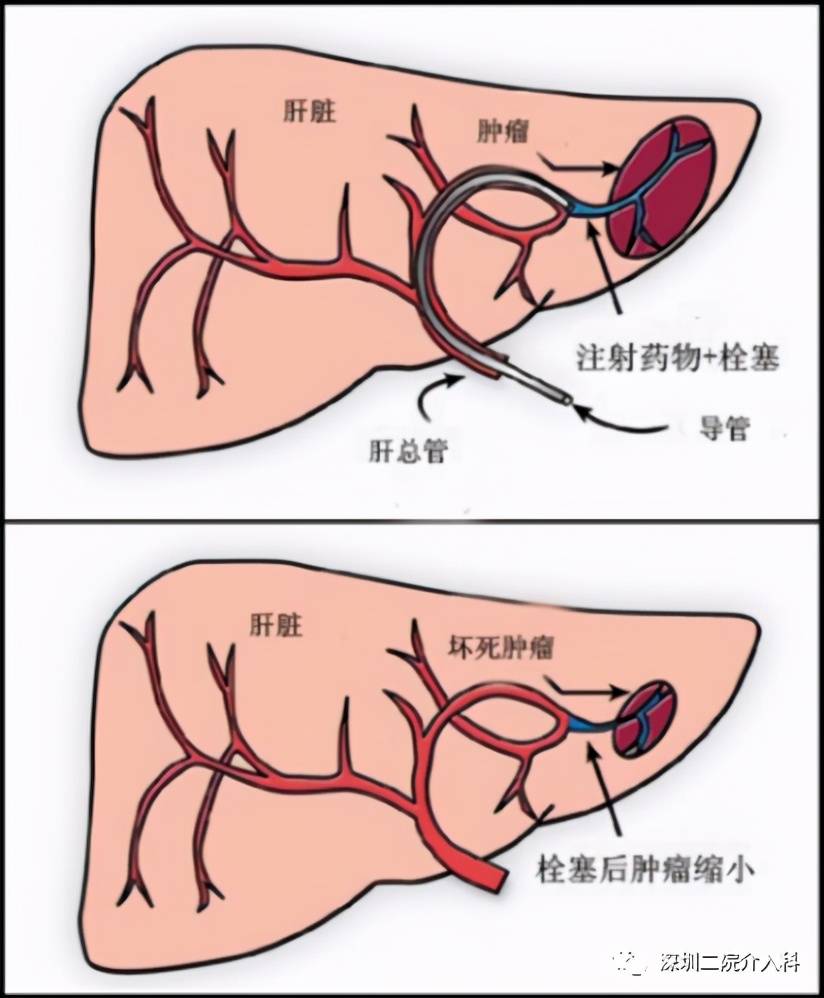 患者|高龄患者得肝癌就要放弃治疗？介入医生说“NO”！