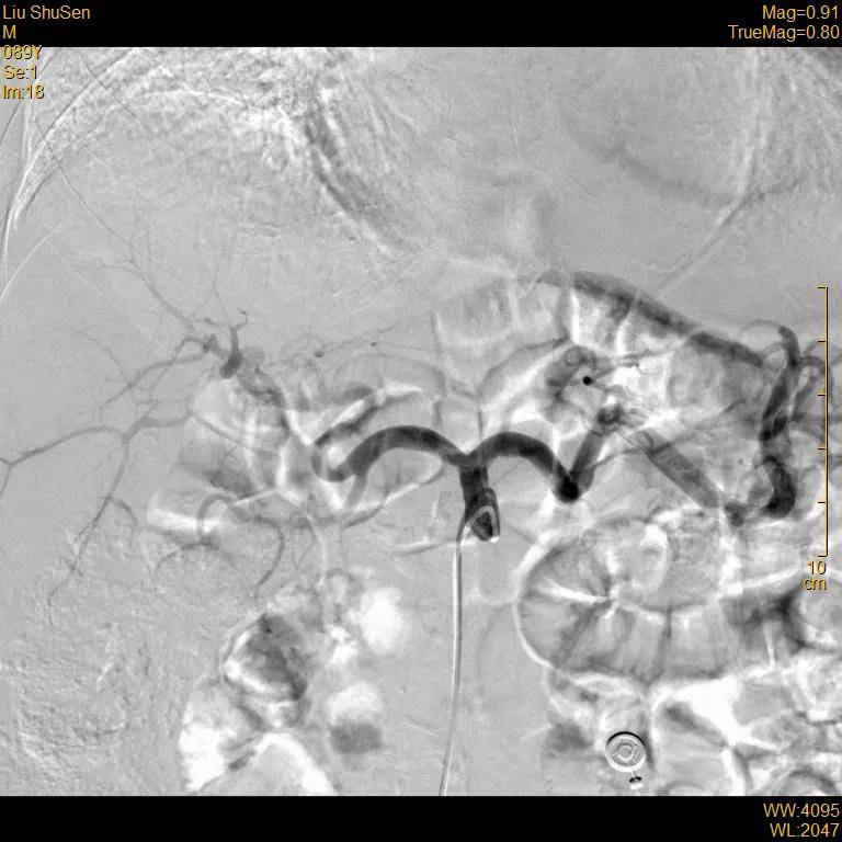 患者|高龄患者得肝癌就要放弃治疗？介入医生说“NO”！