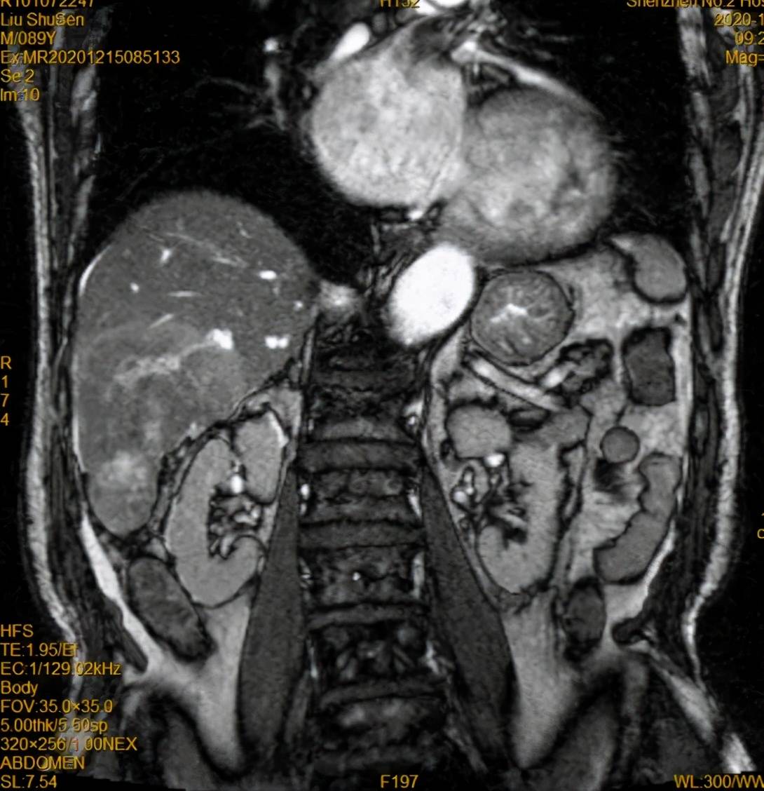患者|高龄患者得肝癌就要放弃治疗？介入医生说“NO”！