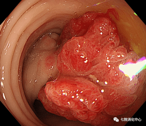 手术|结肠息肉怎么破？内镜帮您来搞定