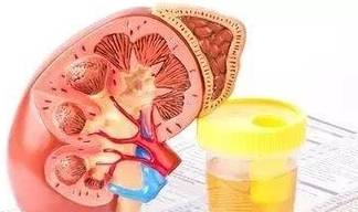 治疗|判断尿蛋白轻重,不能只靠尿常规!