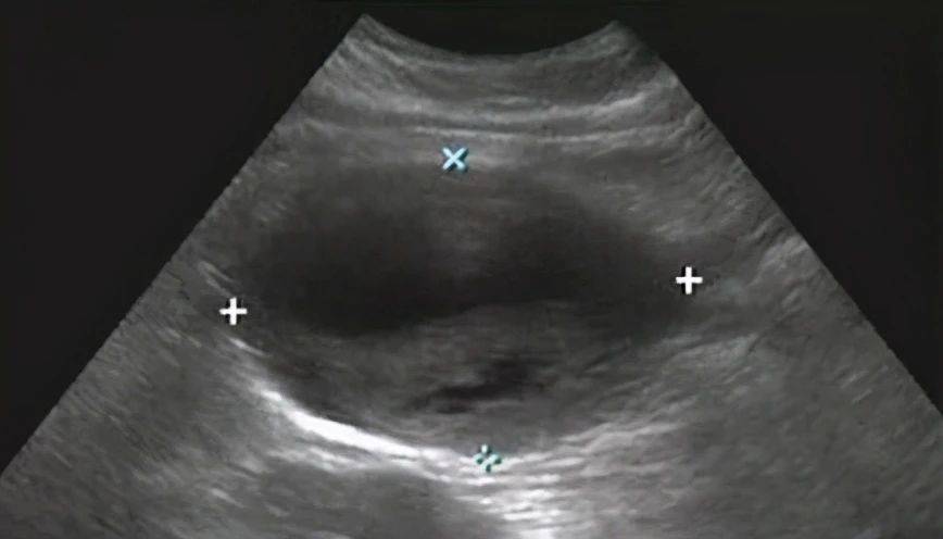 夹层|真性动脉瘤、假性动脉瘤、夹层动脉瘤特点及表现