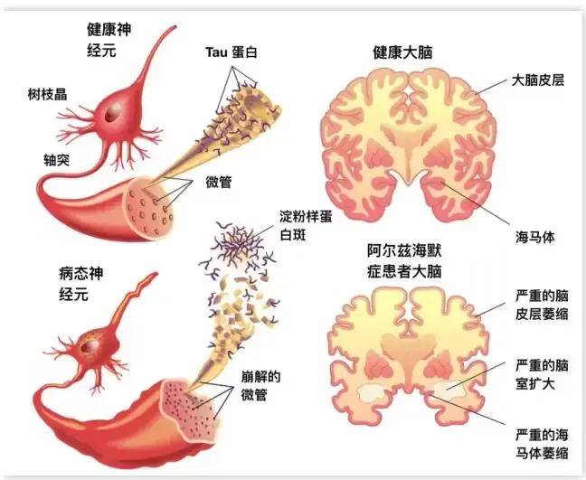 【虾青素大讲堂】虾青素穿越血脑屏障,保卫大脑健康