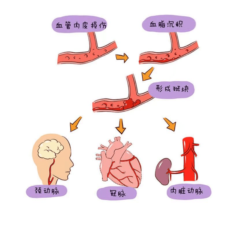 血管|【护心宝典6】什么是冠心病？
