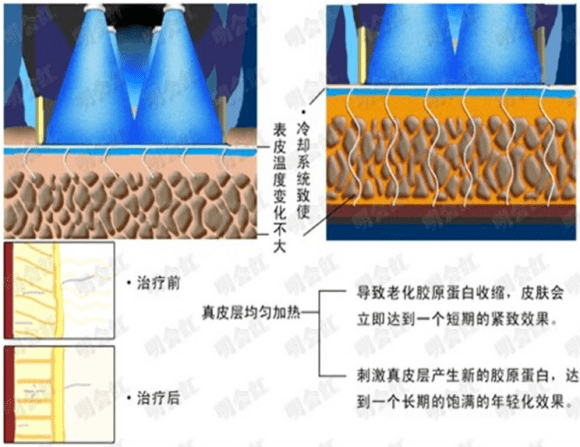 玛吉|热玛吉原理及作用原来是这样，怪不得被称为去皱神器