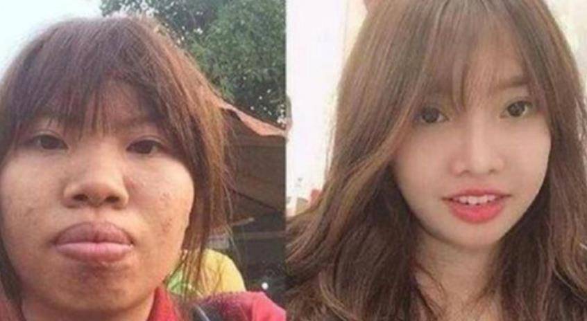 因为|越南女孩因长得丑遭嘲笑，整容后嫁给富豪，没成想孕期“现原形”