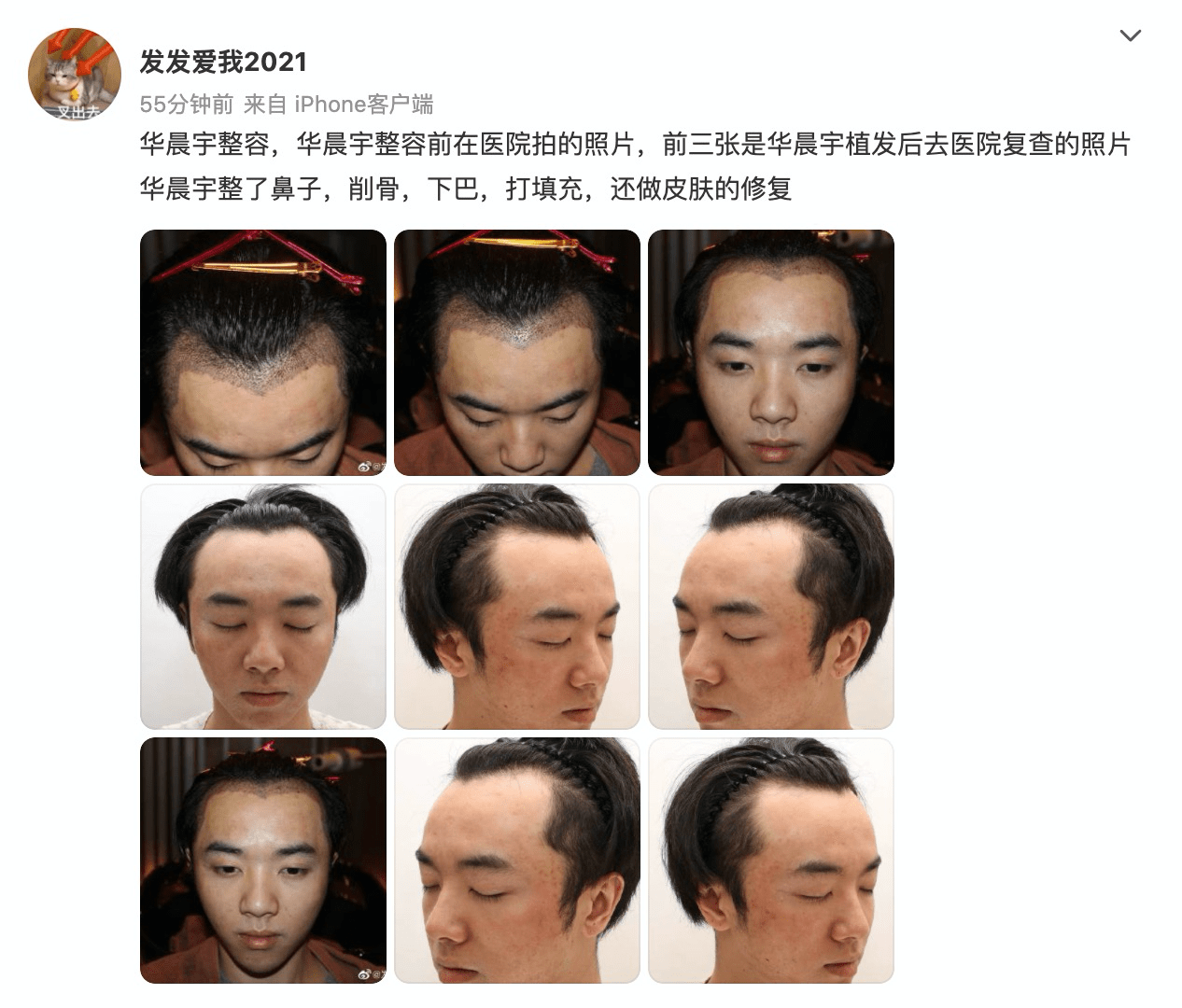 禁言|华晨宇被曝整容植发!前女友爆料!