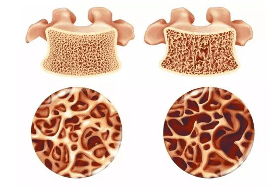 上海强直医院股骨头诊疗中心谈:激素药物是如何引发骨坏死的