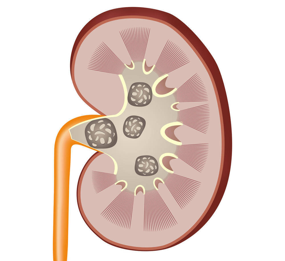 尿酸|都说要多喝水，但多喝水真的好吗？