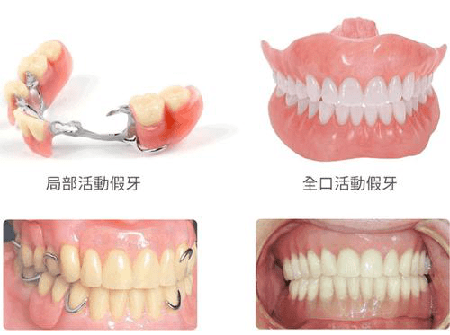 假牙|【老年健康宣传周】活动假牙佩戴指导，看这篇就够了