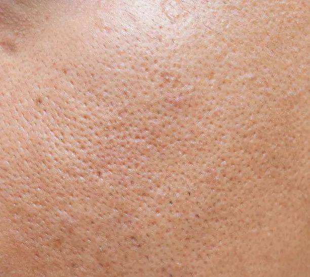 方法|毛孔粗大该用哪款水光?常见原因及解决方法,通通告诉你~