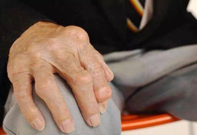 免疫斑点法,这些都是了解免疫性疾病的,尤其是类风湿性关节炎等问题的