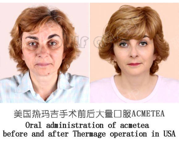 玛吉|热玛吉一个部位是什么意思？不知道的女生请围观