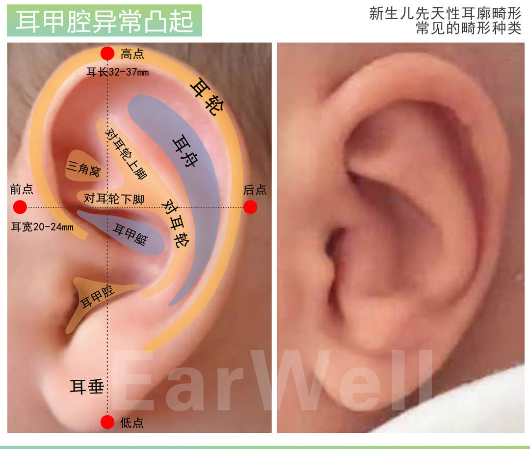 耳甲异常—耳甲反弓,包括耳甲腔中耳轮脚异常凸起.