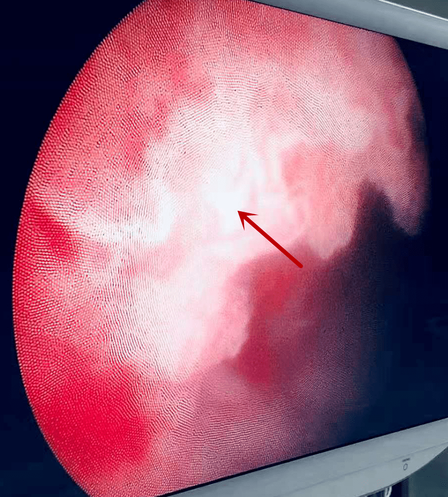 微创钬激光治疗膀胱肿瘤!