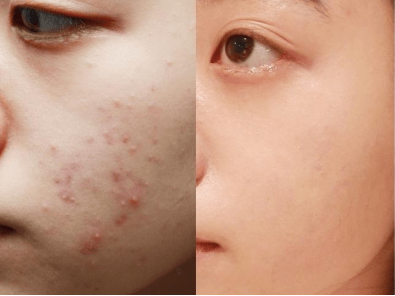 毛周|学生党常见的皮肤问题，首先分清症状，再谈正确护肤