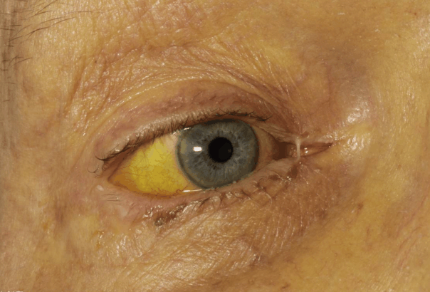 肝脏|肝脏发生病变,身体会以5种方式“抗议”?请你早发现早处理