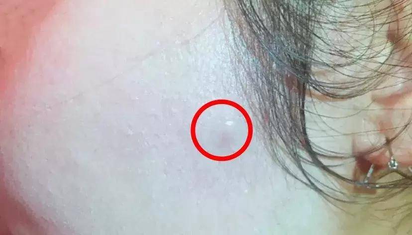 急救|闷热的夏日，这些痘痘急救好物，让你清爽戴口罩！