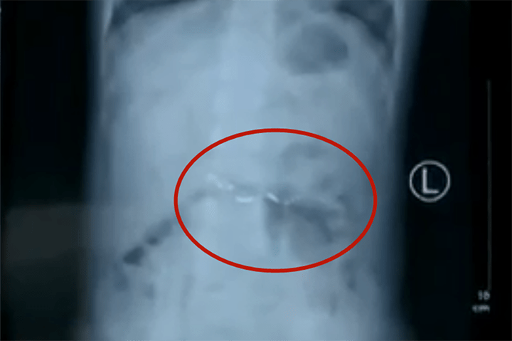 原创6岁孩子打碎温度计误食水银宝爸直接喂牛奶医生真聪明