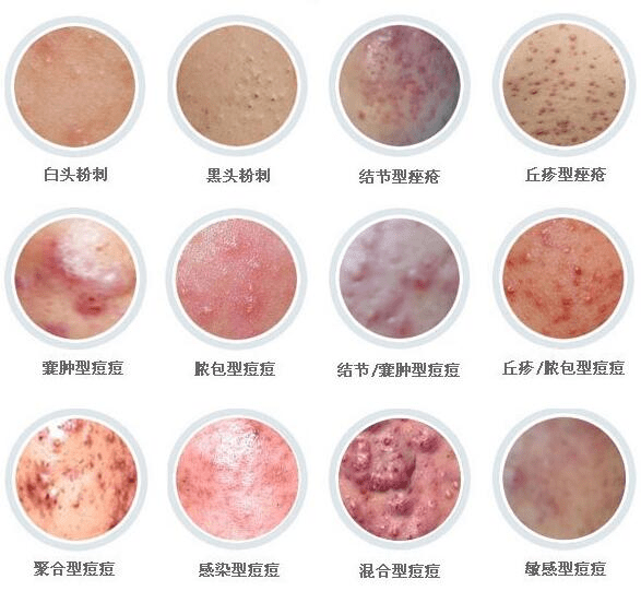 肠道|反复长痘,你护肤的手法正确吗?