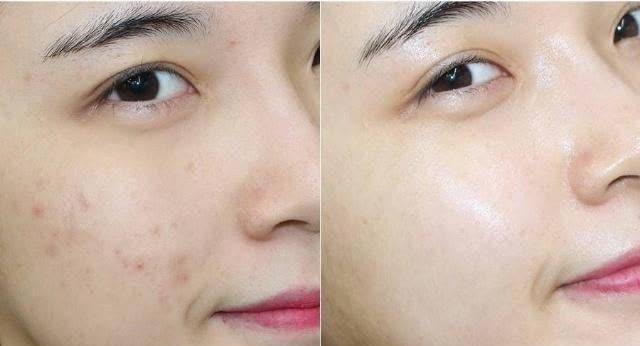 因为|毛孔粗大爱长痘痘?是否“螨虫”在作怪?要看脸上有这些感受没有