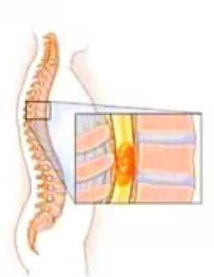肿瘤|钟情于广场舞的张大妈，因为它，出门只能坐轮椅代步！
