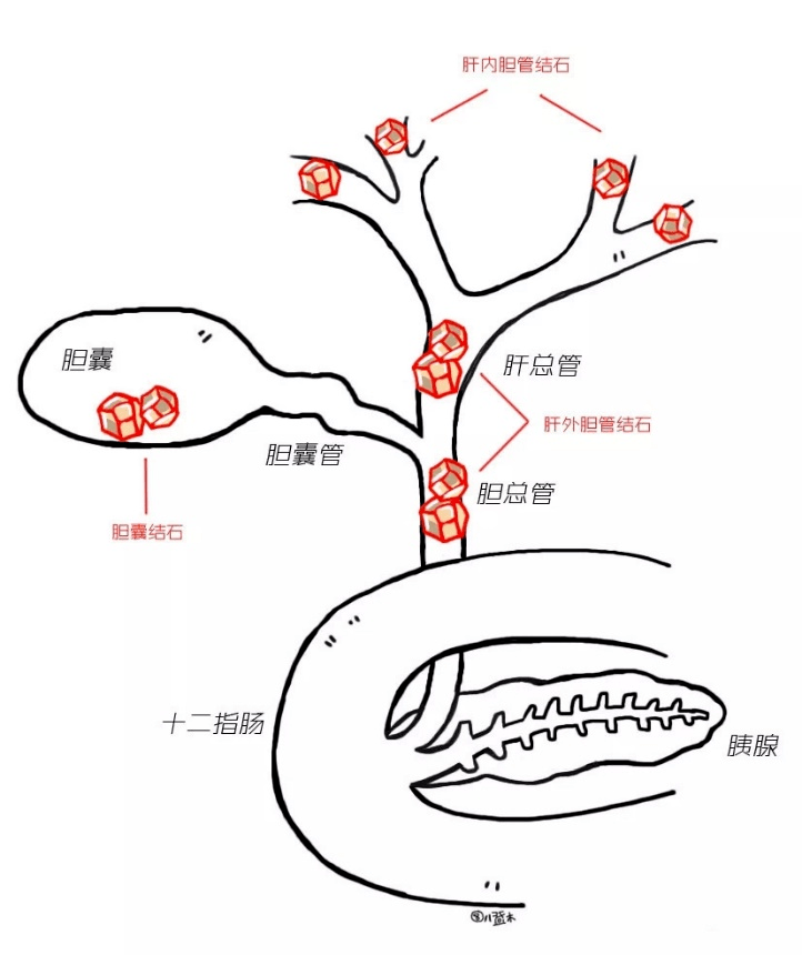 插管|微创！甚至无创！逆行胰胆管造影术取胆总管结石