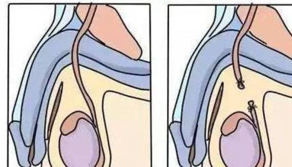方法|被誉为“上环”进化版的新潮避孕，一次可管五年，还不影响要二胎