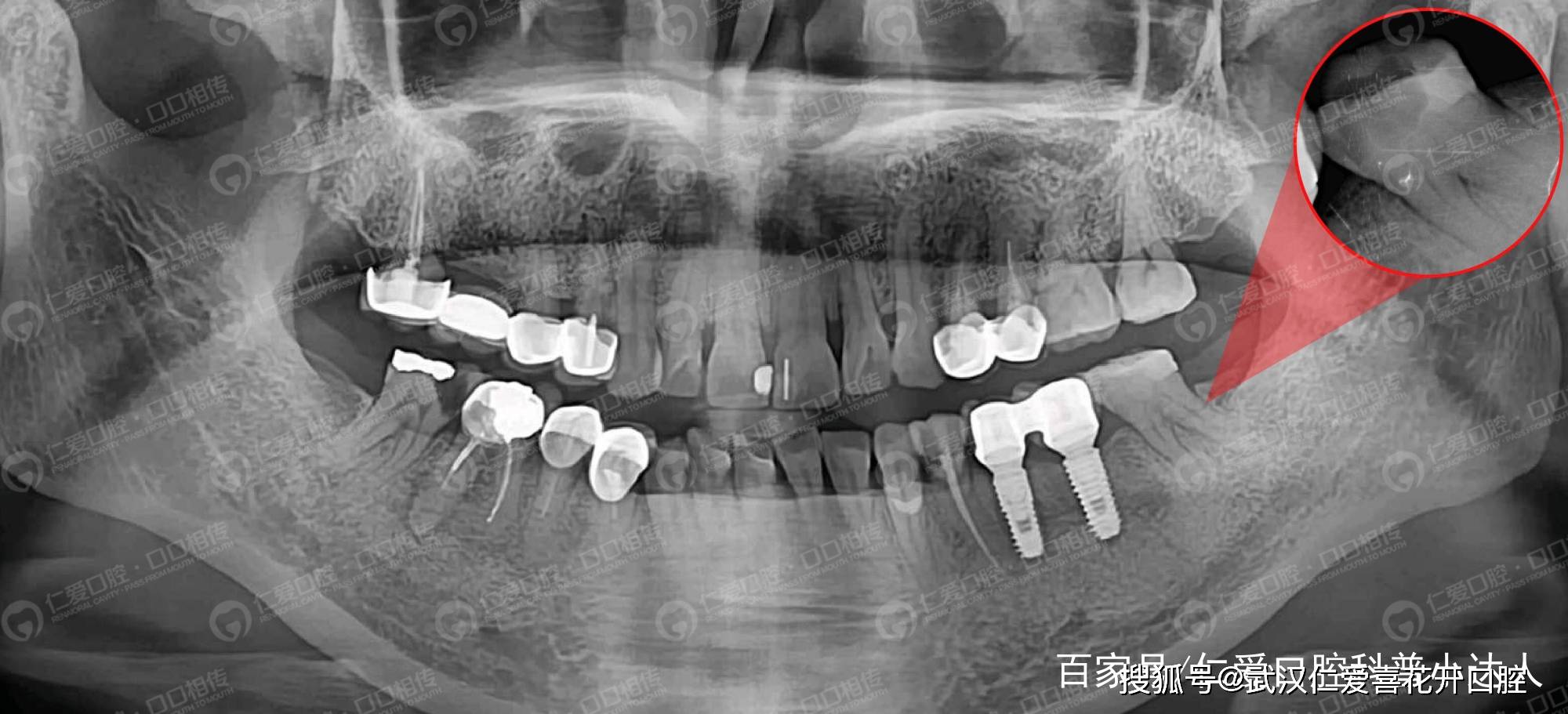 仁爱口腔#医师告诉你:为什么根管治疗要反复拍片?