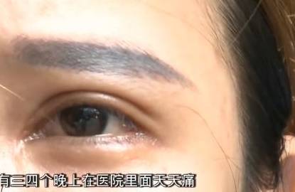 眼睛|21岁女子割双眼皮开眼角后，眼睛红痛视力模糊，医院：眼角膜脱落