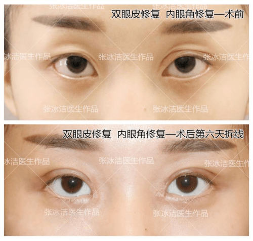 形态|张冰洁医生解析【 内眼角修复】该如何恢复皮下组织的正常“秩序”？