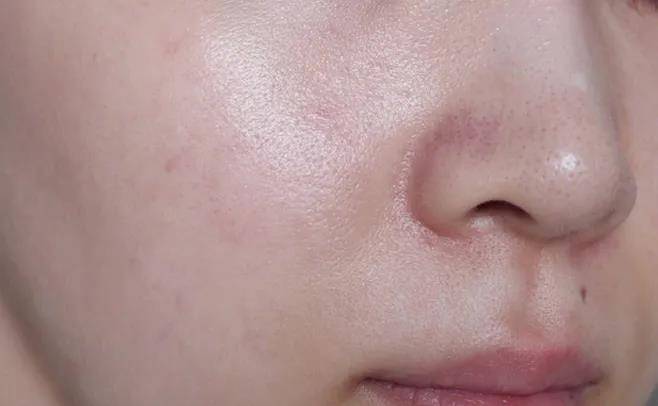 黑头|真正精致的女人，连毛孔都是干净的