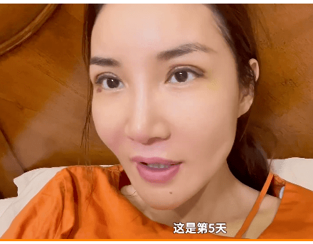 手术后的第5天,翠西tracey称眼角依然有点淤青,但是睁眼睛没有那么