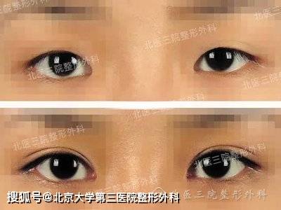 小切口双眼皮 开内眼角 手术
