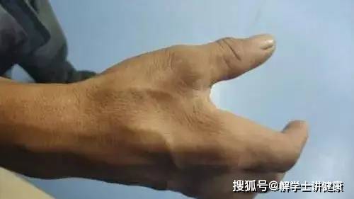 肩胛骨|关于进行性肌营养不良症与重症肌无力的鉴别