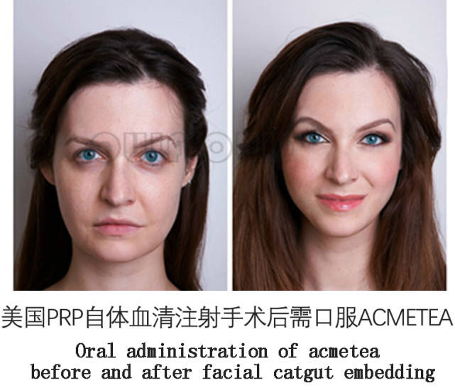 注入|自体血清除皱效果好吗？果然，闺蜜做完自体血清除皱后就变了