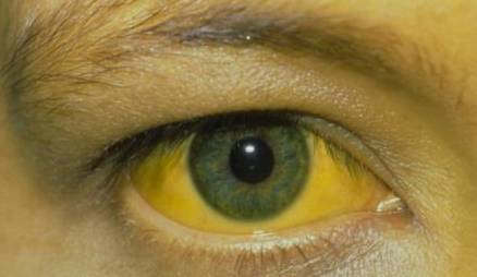 救星|肝硬化的“救星”被发现，不是绿豆，没事喝一点，肝脏悄悄变好了