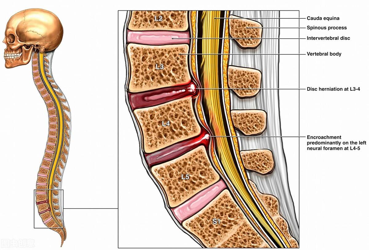 治疗|低颅压综合症，一般是什么症状？