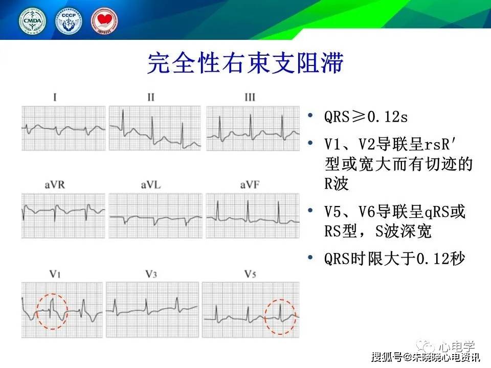 常见心血管疾病基本心电图识别
