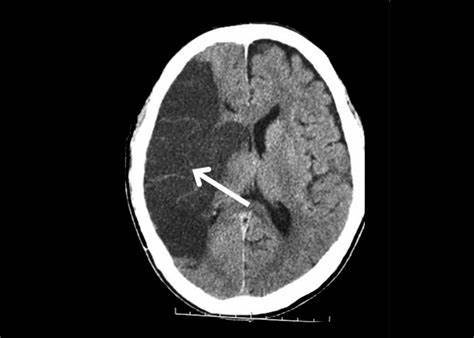 血糖|50岁男子，突发脑梗？医生提醒：远离脑卒中，做到“四个坚持”