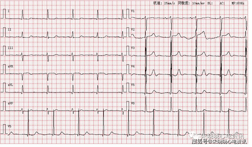 患者男,56歲,因眼部疾病來醫院就診,圖為其體檢心電圖