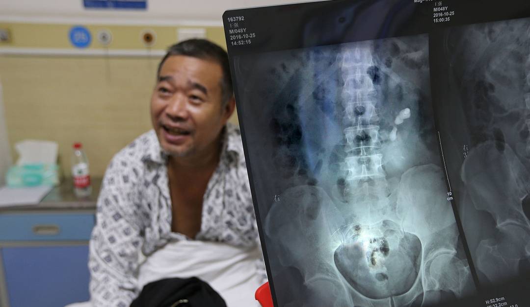 尿酸|高尿酸患者：身体若有4个异象，或是肾已被“伤透”，别再硬抗了