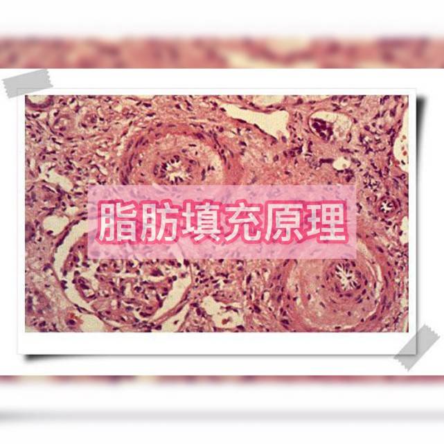 什么|脂肪填充后不断热敷是什么操作，不懂就问别乱来