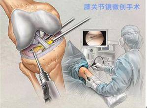 關節鏡治療膝關節骨性關節炎怎麼樣?一篇論文告訴我們這些知識