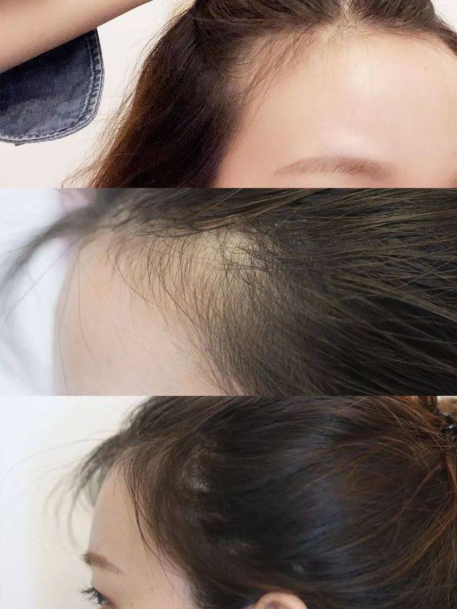 头皮|发际线高怎么改善 让它慢慢长回来