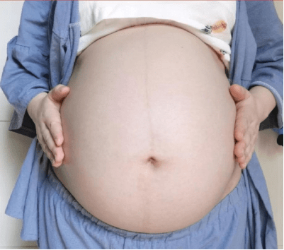 智商|孕期涂橄榄油不长妊娠纹？别交智商税了！做好这些事，远离妊娠纹