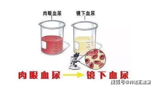 水钠|肾炎“上门”，身体出现这些“信号”，及时把握住，别拖出尿毒症